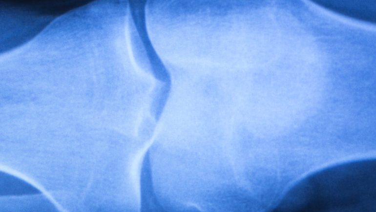 Deformity Correction